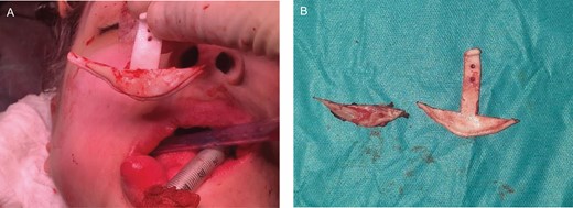 (A, B) Mandibular angles reduction on this 43-year-old transgender patient who underwent male-to-female transition.