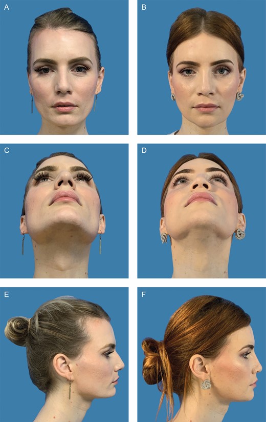 Clinical case of this 30-year-old patient who underwent facial feminization surgery with frontal impaction, mandibular angle resection, and genioplasty. (A) Preoperative front view. (B) Twelve-month postoperative front view. (C) Preoperative bottom view. (D) Twelve-month postoperative bottom view. (E) Preoperative side view. (F) Twelve-month postoperative bottom view.