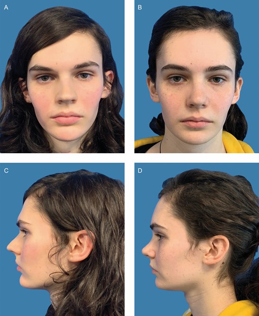 Clinical case of this 21-year-old patient who underwent facial feminization surgery with frontal impaction, mandibular angle resection, and genioplasty. (A) Preoperative front view. (B) Twelve-month postoperative front view. (C) Preoperative side view. (D) Twelve-month postoperative side view.