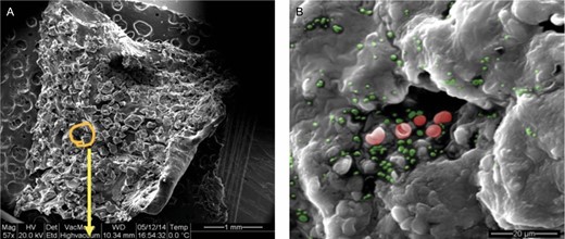 (A) Specimen obtained from peeling off the “Velcro” effect of the inner layer of a double capsule as seen under scanning electron microscopy at 57× magnification. (B) Demonstration of the presence of bacteria as clusters (red and green) seen under scanning electron microscopy at 400× magnification.