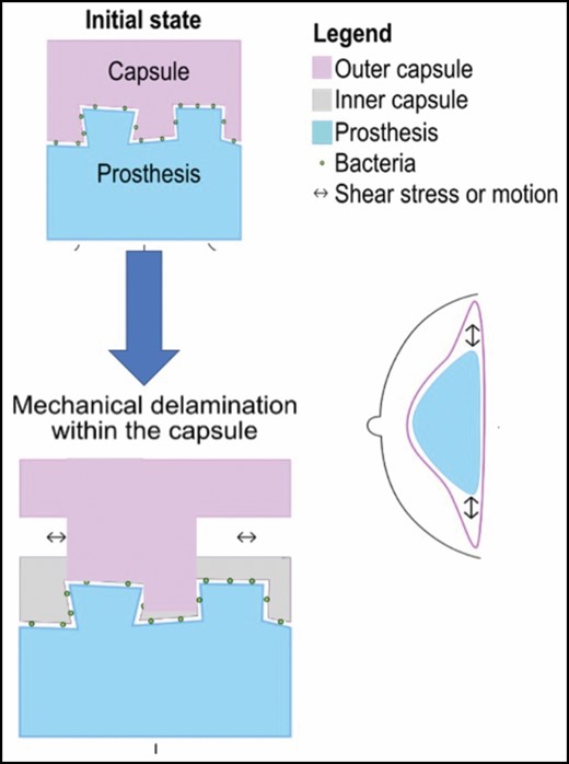 Illustration demonstrating the formation of double capsules by delamination at the border of breast implants of the native inner capsule which remains adherent to the prostheses by the “Velcro” effect.