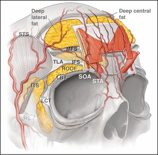 Oblique representation of the fascial and fat compartments of the forehead. By passing directly into the submuscular position deep to orbicularis and frontalis, the supraorbital artery and supratrochlear artery are superficial to the deep fat and corrugator supercilii, inferior and middle septa, deep frontal fascia, and subfrontalis fat. The vessels then change into the superficial position 13-14 mm above the orbital margin. IFS, inferior frontal septum; ITS, inferior temporal septum; LBT, lateral brow thickening; LCT, lateral cantonal thickening; TLA, temporal ligamentous adhesion; MFS, middle frontal septum; ROOF, retro-orbicularis oculi fat; SOA, supraorbital artery; STA, supratrochlear artery; STS, superior temporal septum.