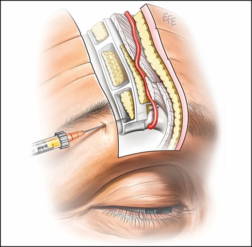 Proposed supraperiosteal plane for filler injection into the brow and low forehead is deep to the retro-orbicularis oculi fat, deep frontalis fascia, and subfrontalis fat separating the vessels from the intended treatment site by 2.3 mm on average.