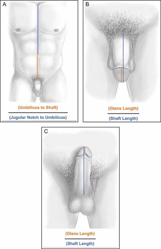 (A) Torso position: the location of the penis on the torso was defined as a ratio of the distance from the umbilicus to the top of the shaft of the penis (orange line) divided by the distance from the jugular notch to the umbilicus (blue line). (B) Dorsal glans ratio: the ratio of the dorsal glans was defined as the length of the glans of the penis divided by the length of the entire externally visible penis. (C) Ventral glans ratio: the ratio of the ventral glans was defined as the length of the glans of the penis divided by the length of the entire externally visible penis. Note that the ventral glans is defined at the confluence of the 2 heads of the ventral glans.