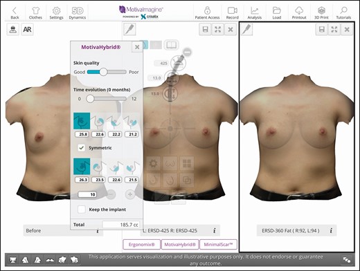 Sample image of a 3-dimensional simulation. (Left) A preoperative image. (Middle) The desired breast size with a 425-cc implant. (Right) A hybrid simulation with a 360-cc implant. The pop-up screen shows the amount of fat to be grafted per breast and per quadrant that was calculated according to the authors’ algorithm. It is interesting to note that the simulation of the hybrid breast and implant-only breast are quite similar, demonstrating to the patient that the equivalent size breast can be achieved with a smaller implant.
