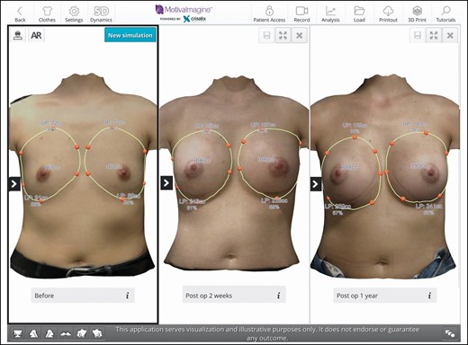 Sample image of a 3-dimensional simulation. (Left) Breast preoperative volume measurement. (Middle) The 2-week total breast postoperative volume. (Right) The 1-year total breast postoperative volume. It is interesting to note that the symmetry of the breasts has improved.