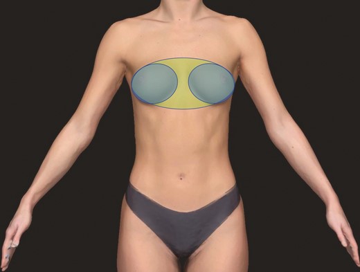 The areas of interest investigated to assess time until first fixation and total time of fixation. The bilateral breasts of a 26-year-old female were assessed individually (blue shape) and the entire mammary region was assessed jointly (green shape).