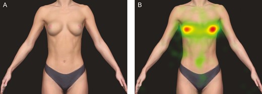 (A) The visual stimulus (26-year-old female, also featured in Figure 1) and (B) the respective averaged eye-tracking heat map of all observers depicting the duration of gaze on the respective area for perfectly symmetric breasts. The red areas in (B) indicate a long duration of stable eye fixation during the 6-second image exposure interval.