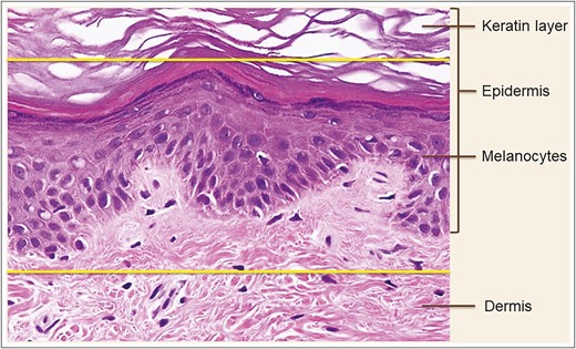 Hematoxylin-eosin staining of skin biopsy prior to microdermal grafting. Partial de-epithelialization: the upper part of epidermis above the upper yellow line is removed. The zone between the upper and lower yellow lines represents the tissue to be harvested for microdermal grafting. Published with permission from Oxford University Press.3