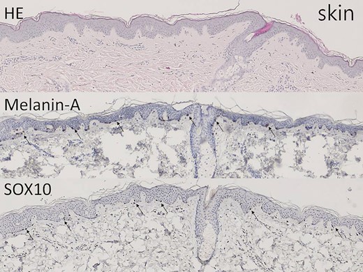 The non–hair-bearing skin tissue shows epidermis and upper dermis on hematoxylin-eosin–stained section (×40). Melanin-A and SOX10 immunostains highlight the melanocytes in the basal layer (arrow, ×40).