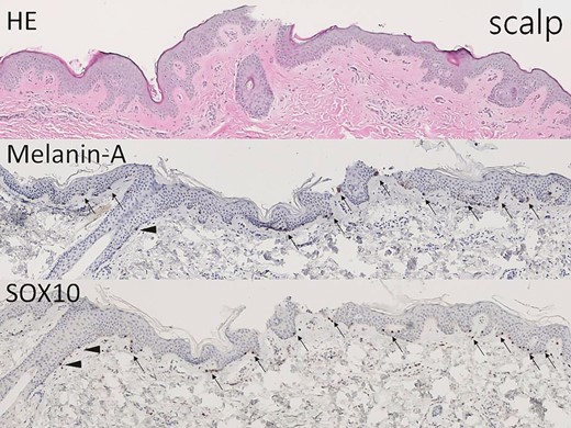 The hair-bearing scalp tissue shows epidermis and upper dermis on hematoxylin-eosin–stained section (×40). Melanin-A and SOX10 immunostains highlight the melanocytes in the basal layer (arrow, ×40) and at the outer root sheath of hair (arrowhead, ×40).