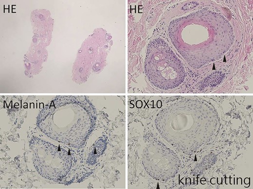 The hair-bearing scalp tissue after knife cutting shows scanty epidermis (×10). However, scattered melanocytes are found at the outer root sheath of hair on hematoxylin-eosin–stained section (arrowhead, ×100). Melanin-A and SOX10 immunostains highlight the melanocytes at the outer root sheath of hair (arrowhead, ×100).