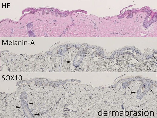 The hair-bearing scalp tissue after dermabrasion shows intermittent lower epidermis on hematoxylin-eosin–stained section (×40). Melanin-A and SOX10 immunostains highlight the melanocytes in the basal layer (arrow, ×40) and at the outer root sheath of hair (arrowhead, ×40).