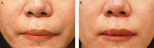 The skin donor site of a 20-year-old female patient with a white forehead scar: (A) preoperative and (B) 3 months after the first treatment session. The scars were treated with microdermal grafts harvested from retroauricular skin and partial de-epithelialization by knife cutting. The color regeneration improvement rate was assessed to be about 50%.