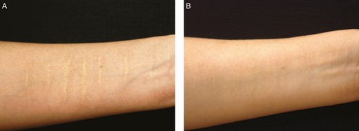 A partial de-epithelialization by knife cutting for a 41-year-old female patient with a white forearm scar: (A) preoperative and (B) 6 months after the first treatment session. The scar was treated with microdermal graft harvested from retroauricular scalp and partial de-epithelialization by knife cutting. The color regeneration improvement rate was assessed to be about 60%.