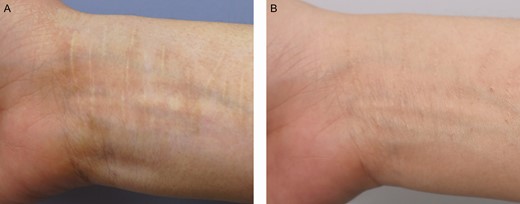 A partial de-epithelialization by dermabrasion for a 34-year-old female patient with a white forearm scar: (A) preoperative and (B) 6 months after the first treatment session. The scar was treated with microdermal graft harvested from retroauricular scalp and partial de-epithelialization by dermabrasion. The color regeneration improvement rate was assessed to be about 65%.