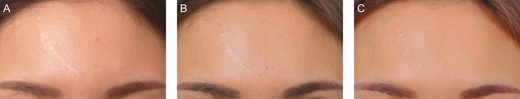 A scalp donor de-epithelized by dermabrasion for a 32-year-old female patient with a white forehead scar: (A) preoperative; (B) 3 months after the first treatment session, when the color regeneration improvement rate was assessed to be about 65%; and (C) 3 months after the second treatment session, when the color regeneration improvement rate was assessed to be about 85%.