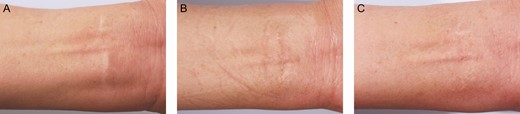 A scalp donor de-epithelized by dermabrasion for a 45-year-old female with a forearm white scar: (A) preoperative; (B) 6 months after the first treatment session, when the color regeneration improvement rate was assessed to be about 60%; and (C) 6 months after the second treatment session, when the color regeneration improvement rate was assessed to be about 80%.