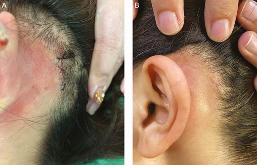 The surgical scar at the donor site of a 40-year-old female patient immediately after scalp donor site harvesting (A) and 6 months later (B). The donor site scar is barely visible.