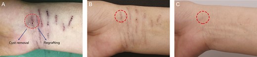 Cyst removal results for a 34-year-old female patient: (A) immediately after removal; (B) 7 days after removal; and (C) 1 year after removal. The second microdermal grafting was performed 6 months after the first treatment session. The epidermal inclusion cyst was removed and regrafted. After 1 year, color regeneration was almost the same as that in sites where cysts had not formed.