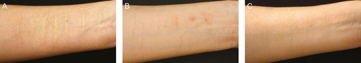 A 41-year-old female patient presenting with white forearm scars: (A) before; (B) 1 month after microdermal grafting treatment, postinflammatory hyperpigmentation appeared; and (C) 5 months after the first treatment session with azelaic acid and hydroquinone, postinflammatory hyperpigmentation was effectively resolved.