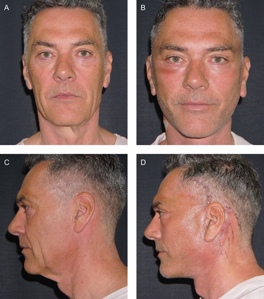 If the intervention is performed according to the standards described in the text, convalescence is usually rather rapid. (A, C) Preoperative and (B, D) 2 days postoperative photos of this 52-year-old male patient at the clinic for removal of the transcutaneous suture network in the infra/retroauricular region. Note the absence of ecchymosis and the presence of only a moderate edema thanks to the limited subcutaneous dissection and the sealing of dead space with fibrin glue and A-net.