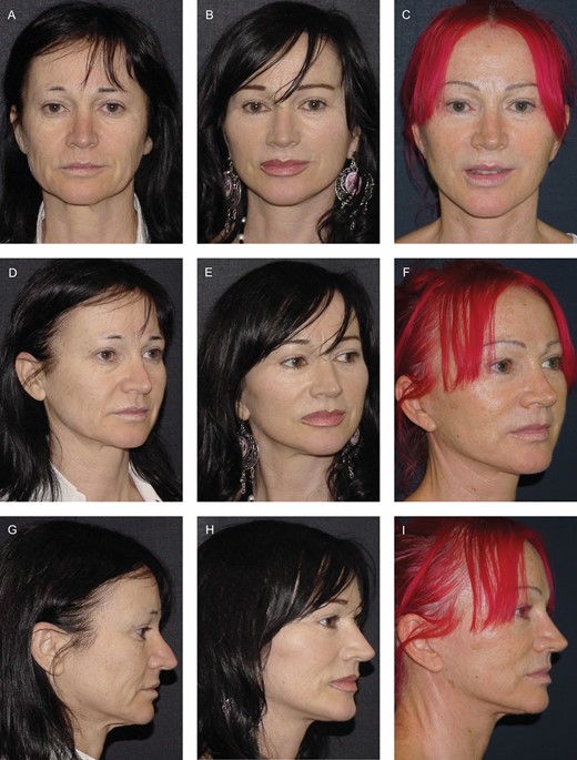 This 45-year-old female patient underwent an extended deep-plane facelift. (A, D, G) Before, (B, E, H) 5 years, and (C, F, I) 15 years after surgery at age 60 years. Note how, utilizing the appropriate technique, the results remained quite stable both in the cheek and neck regions.