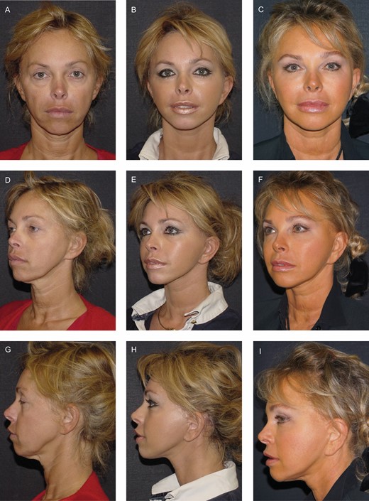 (A, D, G) Before, (B, E, H) 5 years, and (C, F, I) 20 years after sub-periosteal midface lift surgery associated with deep-plane facelift performed in this 48-year-old female patient. It should be noted that long-term stable results are directly related to the young age at which the surgery was performed.