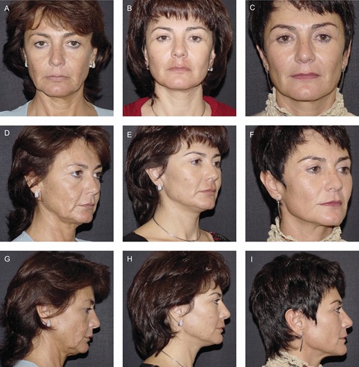 (A, D, G) Before, (B, E, H) 5 years, and (C, F, I) 20 years after sub-periosteal midface lift surgery associated with deep-plane facelift performed in this 53-year-old female patient. Even after 20 years and although the patient lost 8 kg, soft tissue repositioning was maintained well both in the middle facial region (note the level of the nasal-jugal groove) and in the correction of jowls and cervical laxity.