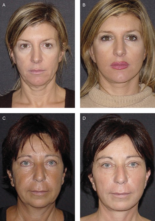 Imbrications and plications comparison: (A, C) preoperative and (B, D) 1-year postoperative photos of these female patients at the age of 44 and 47 years, respectively, demonstrate how the left side treated with imbrication appears in better condition both at the mandibular and neck lines. These cases belong to the series of 30 patients in which the superficial-musculo-aponeurotic-system was repositioned on the left side with imbrications and on the right one only with plication.