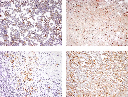 Immunohistochemistry detecting granzyme B as a brown reaction product in anaplastic tumor cells of breast implant–associated anaplastic large cell lymphoma (BIA-ALCL) line TLBR1 (A), a malignant seroma (B), and TNM stage T2 (C) and T3 (D) capsular infiltrates of BIA-ALCL.