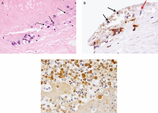 (A) Malignant seroma 8-apoptosis bodies at luminal surface of capsule (hematoxylin and eosin). Adjacent area stained for granzyme B (GrB). (B) Apoptotic bodies (black arrows) associated with GrB (brown reaction product) at luminal side of capsule; a mitotic figure at metaphase is also shown (red arrow, ×400). (C) Malignant seroma 4-GrB+ tumor cells (brown reaction product) and adjacent apoptotic bodies (black arrows, ×600).