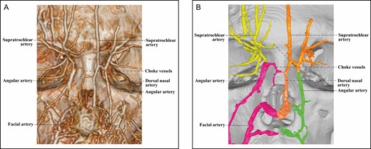 The 3D reconstructed CT of Cadaver No 32, a 26-year-old female, with contrast agent infusion of the facial artery and the superficial temporal artery, demonstrating a Type 1 upper nose with independent bilateral ophthalmic angiosomes that communicate indirectly via a choke vessel. Note that the diameter of the choke vessel is very small compared with that of the dorsal nasal artery of the left ophthalmic angiosome. (A) CT reconstructed with the Philips workstation. (B) CT reconstructed with the Mimics algorithm. CT, computed tomography; 3D, three-dimensional.
