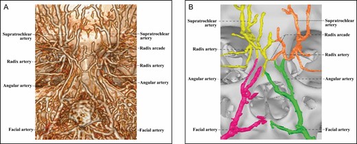 The 3D reconstructed CT of Cadaver No 20, a 23-year-old male, with contrast agent infusion of the bilateral external carotid artery, demonstrating a Type 2A upper nose supplied by bilateral ophthalmic angiosomes with a true anastomosis via 2 radix arcades formed by bilateral radix arteries. (A) CT reconstructed with the Philips workstation. (B) CT reconstructed with the Mimics algorithm. CT, computed tomography; 3D, three-dimensional.