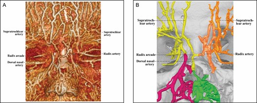 The 3D reconstructed CT of Cadaver No 32, a 26-year-old female, with contrast agent infusion of the facial artery and the superficial temporal artery, demonstrating a Type 1 upper nose with independent bilateral ophthalmic angiosomes that communicate indirectly via a choke vessel. Note that the diameter of the choke vessel is very small compared with that of the dorsal nasal artery of the left ophthalmic angiosome. (A) CT reconstructed with the Philips workstation. (B) CT reconstructed with the Mimics algorithm. CT, computed tomography; 3D, three-dimensional.