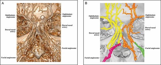 The 3D CT of Cadaver No 28, a 41-year-old male, with contrast agent infusions of the bilateral facial artery and superficial temporal artery, demonstrating a Type 2C upper nose supplied by bilateral ophthalmic angiosomes with a true anastomosis via the converged and then merged bilateral dorsal nasal arteries. (A) CT reconstructed with the Philips workstation. (B) CT reconstructed with the Mimics algorithm. CT, computed tomography; 3D, three-dimensional.