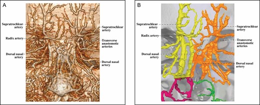 The 3D reconstructed CT of Cadaver No 44, a 40-year-old female, with contrast agent infusion of the external carotid artery, demonstrating a Type 2C upper nose supplied by bilateral ophthalmic angiosomes with a true anastomosis via transversely connected bilateral dorsal nasal arteries. (A) CT reconstructed with the Philips workstation. (B) CT reconstructed with the Mimics algorithm. CT, computed tomography; 3D, three-dimensional.