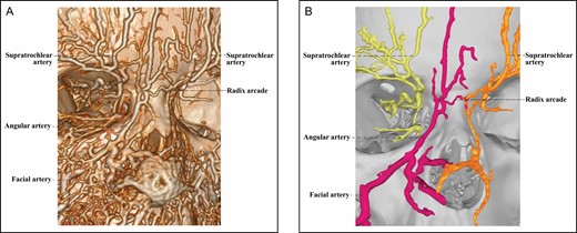 The 3D reconstructed CT of Cadaver No 27, a 35-year-old female, with contrast agent infusions of the bilateral facial artery and superficial temporal artery, demonstrating a Type 3A upper nose supplied by the right facial and left ophthalmic angiosomes with a true anastomosis via a radix arcade. The radix arcade is formed by the right radix artery from the angular artery of the facial angiosome and the left radix artery from the ophthalmic angiosome. (A) CT reconstructed with the Philips workstation. (B) CT reconstructed with the Mimics algorithm. CT, computed tomography; 3D, three-dimensional.