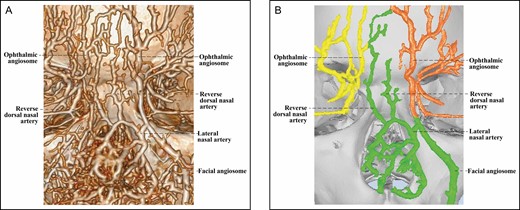 The 3D reconstructed CT of Cadaver No 9, a 25-year-old male, with contrast agent infusions of the bilateral external carotid artery, demonstrating a Type 3B upper nose in which the lateral nasal artery of the right facial angiosome branches off a reverse dorsal nasal artery running cranially to form a true anastomosis with the supratrochlear artery of the left ophthalmic angiosome. (A) CT reconstructed with the Phillips workstation. (B) CT reconstructed with the Mimics algorithm. CT, computed tomography; 3D, three-dimensional.