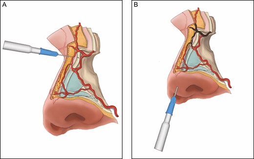 Recommended technique for safe upper nasal dorsum filler injection. (A) Filler for concave nasal radix can be safely injected with a new 27G needle, which allows a reliable aspiration test. The direction of the needle should be perpendicular to the bony surfaces of the midline dorsum, and the filler should be injected into the nasal periosteum. (B) Filler for dorsum augmentation can also be safely injected with a blunt cannula by “hugging” the midline nasal periosteum/perichondrium; however, cannula injection of the filler at the concave nasal radix carries a particularly high risk of blindness, because the tip of the cannula is unable to stay on the radix periosteum due to the concavity. Instead, the tip of the cannula may penetrate the radical soft tissue where there are true anastomotic arteries (highlighted in brownish gray) directly linked to the ophthalmic angiosomes.