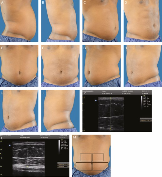 This 30 year-old male subject weighed 96.6 kg prior to treatment. At 12 weeks posttreatment, he weighed 96.8 kg, his mean abdominal fat thickness decreased 49.0%, and his circumference decreased 6 cm. A representative ultrasound image is shown, pretreatment and 12 weeks posttreatment. An orientation diagram of approximate treatment locations is shown for reader orientation. Pretreatment and posttreatment images at 12 weeks following 1 treatment: (A, B) right lateral, (C, D) right oblique, (E, F) frontal, (G, H) left oblique, (I, J) left lateral, (M) orientation view of treatment areas, (K, L) representative pretreatment ultrasound.