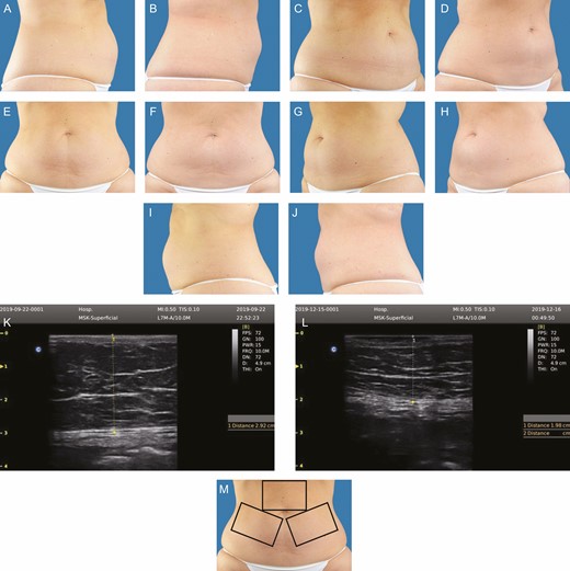 This 48-year-old female subject weighed 83.6 kg prior to treatment. At 12 weeks posttreatment, she weighed 82.5 kg, her abdominal fat thickness decreased 28.6%, and her circumference decreased 8 cm. A representative ultrasound image is shown, pretreatment and 12 weeks posttreatment. An orientation diagram of approximate treatment locations is shown for reader orientation. Pretreatment and posttreatment images at 12 weeks following 1 treatment: (A, B) right lateral, (C, D) right oblique, (E, F) frontal, (G, H) left oblique, (I, J) left lateral, (M) orientation view of treatment areas, (K, L) representative pretreatment ultrasound.