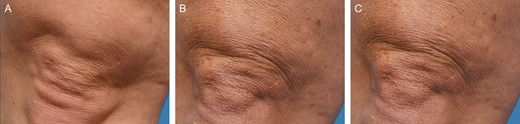 Representative clinical photography series of a 46-year-old female subject at baseline (A), 3 months posttreatment (B), and 6 months posttreatment (C).