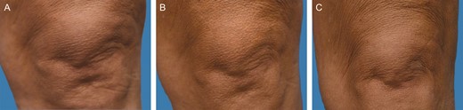 Representative clinical photography series of a 44-year-old female subject at baseline (A), 3 months posttreatment (B), and 6 months posttreatment (C).