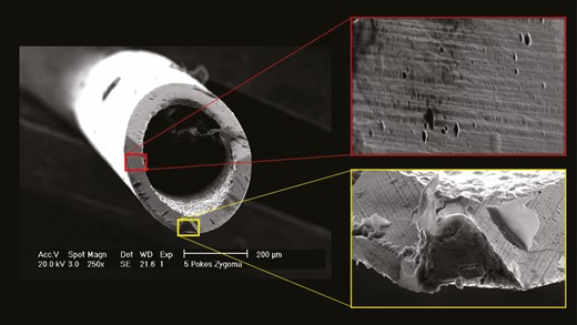Comparison of damaged areas (yellow) and undamaged areas (red) on the surface of a 27G needle.