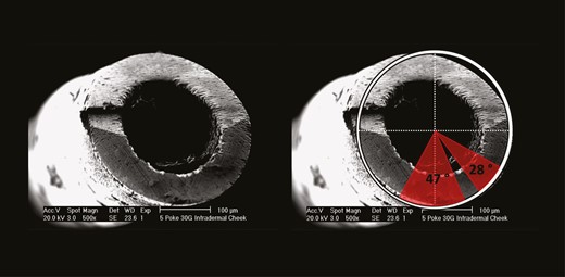 Analysis pattern of damaged areas on the needle surface. The red borders indicate damaged areas on the surface of a 30G needle after 5 subdermal injections into the cheek. The size of damaged areas is presented in degrees.