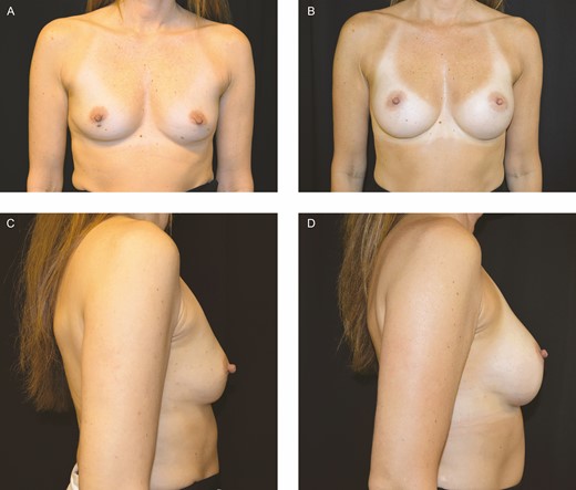 (A, C) Preoperative photos of this 38-year-old woman who underwent primary breast augmentation with 230-cc nanotextured implants. (B, D) Appearance at 13 months postoperatively.