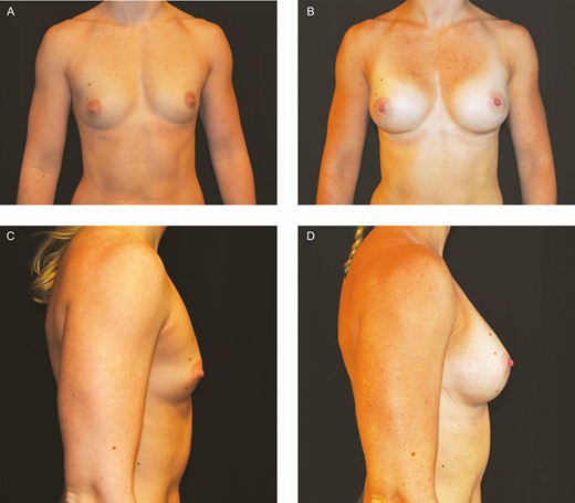 (A, C) Preoperative photos of this 30-year-old woman who underwent primary breast augmentation with 240 cc conventional textured implants. (B, D) Appearance at 14 months postoperatively.