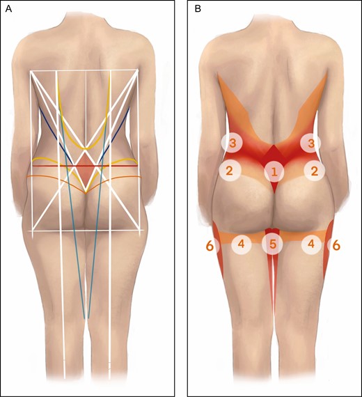 (A) Posterior illustration of trunk, buttocks, and thighs. A rectangle (white) is drawn on the posterior trunk connecting the bilateral posterior axillary fold and bilateral lower lateral buttock. In this rectangle, the sacral diamond (white outline with red center) is determined by drawing the posterior axillary fold-lower lateral buttock and posterior axillary fold-intergluteal crease lines. The ISU line (red) connects the sacral dimples to the sides and towards the umbilicus (red). The desired superior gluteal crease (yellow) is drawn by connecting the intergluteal region to the iliac crest. A line (orange) is drawn from the intergluteal region that extends laterally below the ISU line and above the lateral thigh concavity, indicating tunnelization and lipoaspiration is desired above this level. The posterior body diagonal (turquoise) is drawn by connecting dorsal midaxillary point to the pes anserinus. A vertical dorsal midaxillary point-midpoint of the fossa poplitea axis (white) is designed that determines the horizontal coordinate of the gluteal maximal projection point. An outward-bending trapezius line (yellow) indicates the lateral border of the trapezius muscles and the edge of the liposuction zone. The line connecting the axillary fossa to the ipsilateral sacral dimple (blue) connects the axillary fossa to the ipsilateral dimple. (B) The designed pattern helps to determine zones of liposuction of varying intensity. Maximal aspiration zones are marked in bright red, medium aspiration zones in pink, and minimal aspiration/tunnelization zones in orange. Zones: 1, sacral diamond; 2, posterior lower flank; 3, posterior upper flank; 4, posterior thigh; 5, posterior inner thigh; 6, lateral thigh. ISU, line connecting the indentations at the lateral angles of the sacral diamond with the sides and umbilicus.