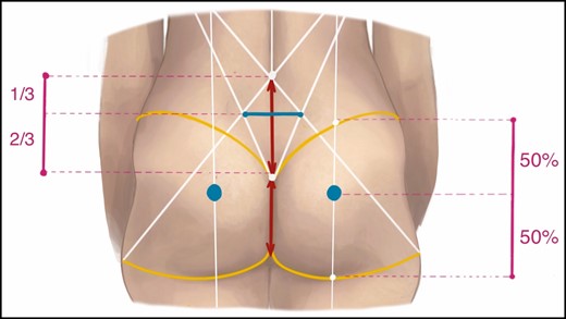 Detail of the sacral diamond (white), which can be located by connecting the posterior axillary fold to the contralateral lower lateral buttock (junction of lower lateral buttock and inferior gluteal crease line) and by connecting the posterior axillary fold to the upper border of the intergluteal crease (white lines). At the junction of the superior one-third and lower two-thirds in this diamond, the dimple location is verified at an approximate horizontal distance (blue line) of 5 to 5.5 cm from the midline (red line). Alternatively, in a patient with visible or palpable sacral indentations, the sacral diamond can be designed by connecting the posterior axillary fold to the ipsilateral dimple as well as by connecting the posterior axillary fold to the contralateral dimple. The ideal point of maximal projection (blue dot) in a buttock is determined at a 50:50 ratio between the upper gluteal edge (level of the iliac crest, yellow) and the lower gluteal edge (yellow) along the vertical dorsal midaxillary point-fossa poplitea line (white).